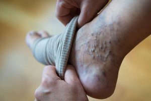  آیا جوراب واریس تاثیر دارد؟ پاسخ علمی و واقعی